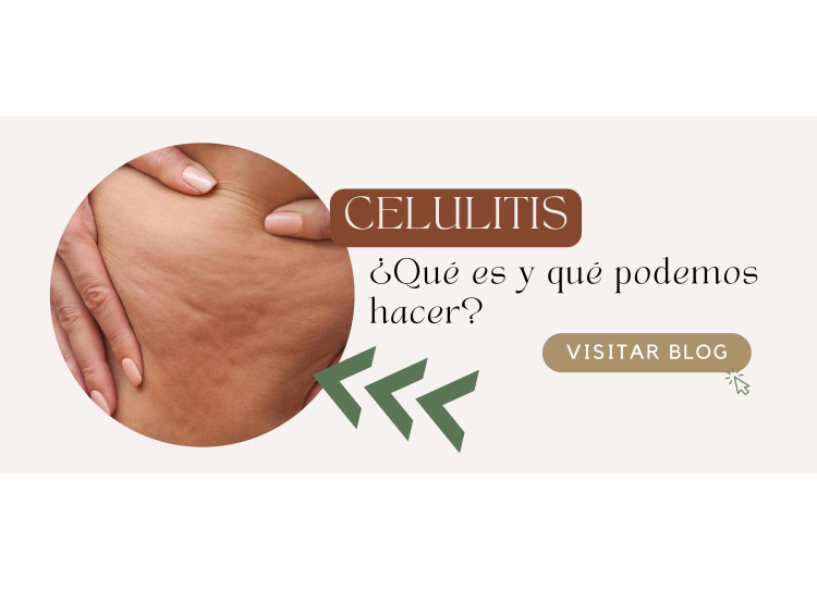 ¿Tengo Celulitis qué hago?